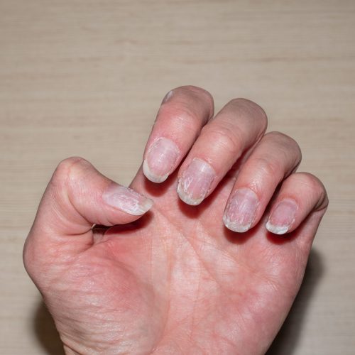 Close- up of bitten and brittle nails without manicure. Overgrown cuticle fingernails and tainted nail plate. Cuticle overgrown nails and damaged nail plate. Concept of nail care and health. Close- up of bitten and brittle nails without manicure. Overgrown cuticle fingernails and tainted nail plate. Cuticle overgrown nails and damaged nail plate. Concept of nail care and health.